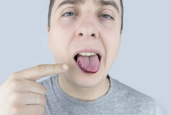 Black Tongue Man Shows Consequences Injury Bite Burn Tongue Part — Stock Photo, Image