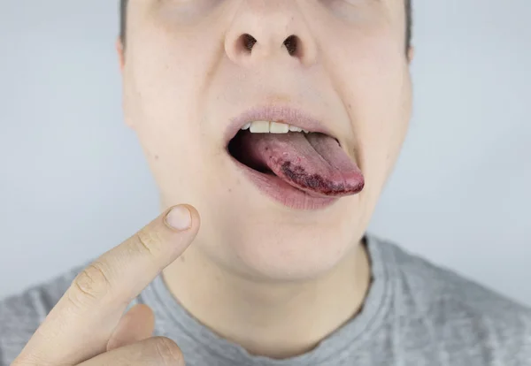 黑舌男人表现出受伤 咬伤或舌头灼伤的后果 部分受损 国内伤害的治疗 — 图库照片