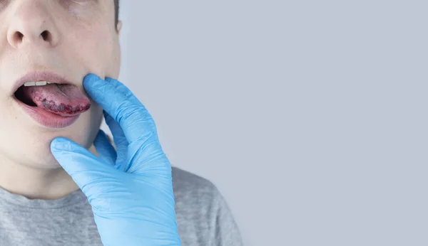 Black Tongue Man Shows Consequences Injury Bite Burn Tongue Part — Stock Photo, Image