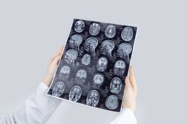 Beyin MR 'ı. Nöropatolog, patolojileri ve yaralanmaları görmek için arka planda bir resim tutuyor. Nöroalji, epilepsi ve diğer patolojilerin teşhisi ve tedavisi