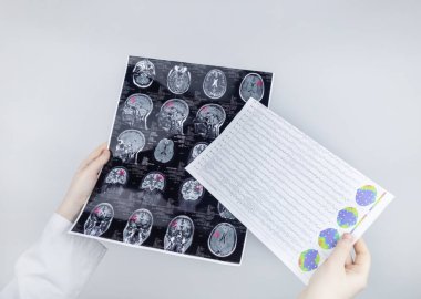 Epileptolog hasta MRI ve elektroansefalogramı inceliyor. Epilepsi tedavisi ve bu hastalıktan muzdarip insanlara yardım etme kavramı. Nörolog. Beynin patolojisi. Nöbet aktivitesi