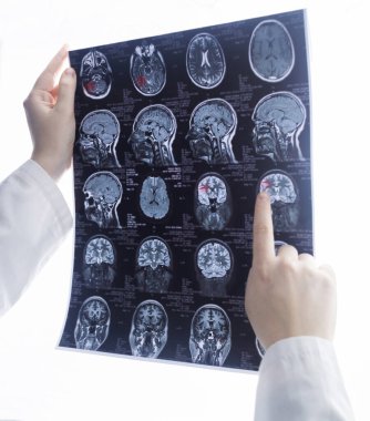 Epileptologist examines patient MRI and electroencephalogram. Concept treating epilepsy and helping people who suffer from this disease. Neurologist at work. Pathology of the brain. Seizure activity