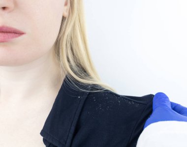 Sarışın bir kadının omzunda kepek. Siyah gömleğinde daha çok kepek gevreği olan bir kadının yan görüntüsü. Kafa derisi hastalığı tedavi konsepti. Mantar enfeksiyonundan dolayı rahatsızım. Baş mantarı