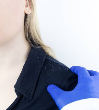 Sarışın bir kadının omzunda kepek. Siyah gömleğinde daha çok kepek gevreği olan bir kadının yan görüntüsü. Kafa derisi hastalığı tedavi konsepti. Mantar enfeksiyonundan dolayı rahatsızım. Baş mantarı