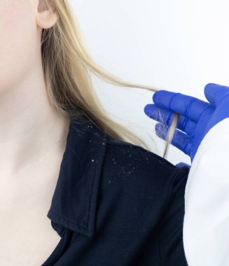 Sarışın bir kadının omzunda kepek. Siyah gömleğinde daha çok kepek gevreği olan bir kadının yan görüntüsü. Kafa derisi hastalığı tedavi konsepti. Mantar enfeksiyonundan dolayı rahatsızım. Baş mantarı