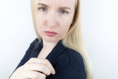 Dandruff on a blond woman shoulder. Side view of a female who has more dandruff flakes on his black shirt. Scalp disease treatment concept. Discomfort from a fungal infection. Head fungus