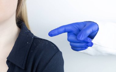 Sarışın bir kadının omzunda kepek. Siyah gömleğinde daha çok kepek gevreği olan bir kadının yan görüntüsü. Kafa derisi hastalığı tedavi konsepti. Mantar enfeksiyonundan dolayı rahatsızım. Baş mantarı