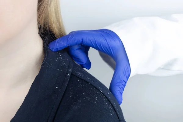 Dandruff on a blond woman shoulder. Side view of a female who has more dandruff flakes on his black shirt. Scalp disease treatment concept. Discomfort from a fungal infection. Head fungus