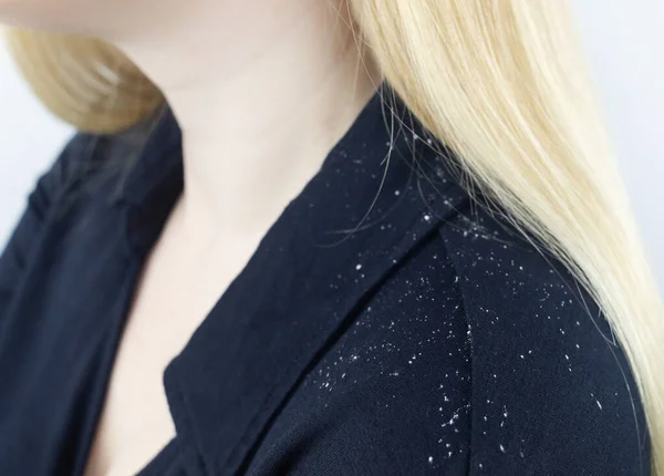 Dandruff Blond Woman Shoulder Side View Female Who Has More — Stock Photo, Image