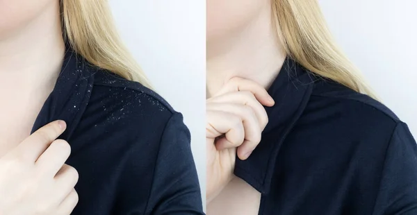 Dandruff on a blond woman shoulder. Side view of a female who has more dandruff flakes on his black shirt. Scalp disease treatment concept. Discomfort from a fungal infection. Head fungus