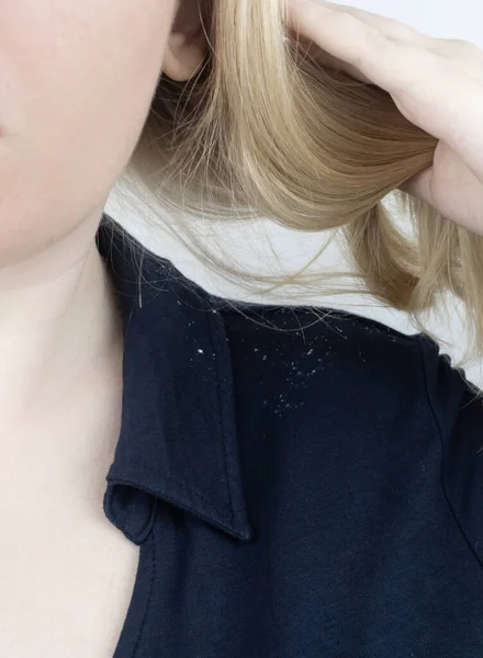 Dandruff on a blond woman shoulder. Side view of a female who has more dandruff flakes on his black shirt. Scalp disease treatment concept. Discomfort from a fungal infection. Head fungus