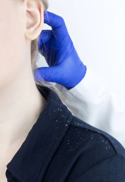 Dandruff on a blond woman shoulder. Side view of a female who has more dandruff flakes on his black shirt. Scalp disease treatment concept. Discomfort from a fungal infection. Head fungus