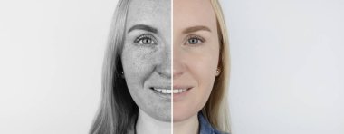 Deride morötesi ışınlar. Koruyucu krem testi. Soldaki deri korunmasız ve ultraviyole ışıktan kaynaklanan lekeler görülebilir. Sağda, özel ürünlerin koruması altında cilt temizdir..