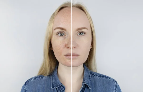 皮肤上的紫外线 保护层测试 左边的皮肤是无防护的 上面可见紫外线照射后的污迹 右边的皮肤在特殊产品的保护下是干净的 — 图库照片