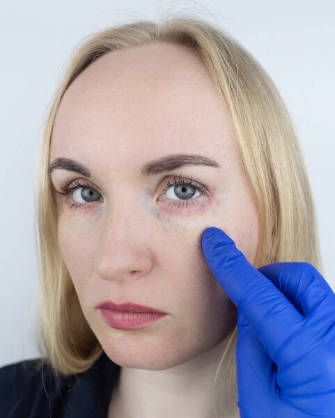 Аллергия на косметику. Девушка смотрит на прыщи вокруг глаз, которые появились после использования токсичной косметики. Красные пятна на коже женщины