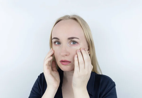 Allergie Voor Cosmetica Het Meisje Kijkt Naar Puistjes Rond Haar — Stockfoto