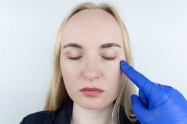 Kozmetiğe alerjisi var. Kız zehirli kozmetik ürünleri kullandıktan sonra ortaya çıkan sivilcelerine bakıyor. Kadın teninde kırmızı lekeler