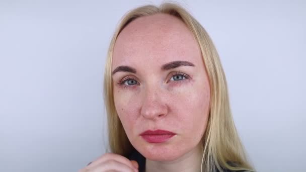 Allergi Mot Kosmetika Flickan Tittar Finnar Runt Ögonen Som Dök — Stockvideo