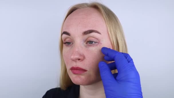化粧品へのアレルギー 毒性の化粧品を使用した後に現れた瞳の周りのにきびを見ている少女 女性の皮膚の赤い斑点 — ストック動画