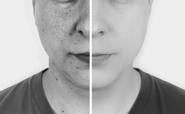 Ultrafialové Paprsky Kůži Test Ochranných Krémů Vlevo Kůže Nechráněná Jsou — Stock fotografie