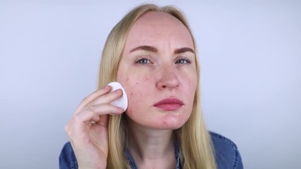对化妆品过敏 女孩从劣质的奶油 粉末或粉底霜中长出粉刺 对不合标准或有毒产品的皮肤反应概念 — 图库视频影像