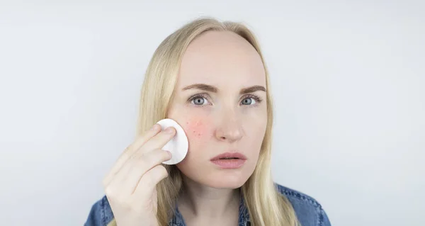 Allergia Kozmetikumokra Lány Pattanásos Lett Egy Rossz Minőségű Krémtől Púdertől — Stock Fotó
