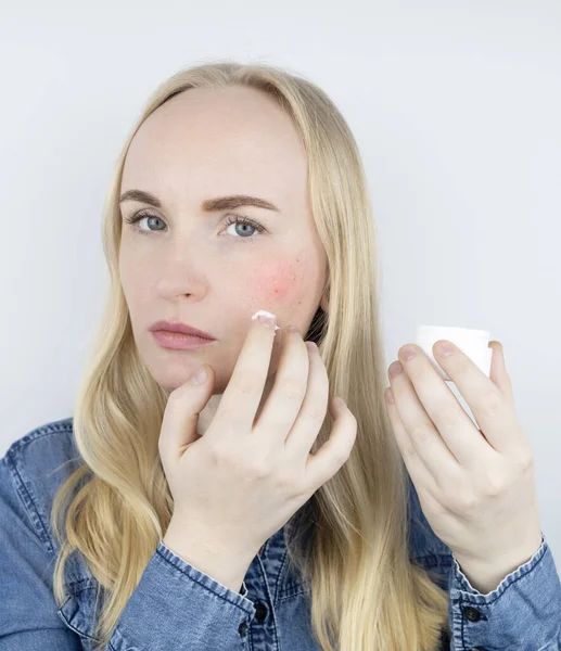 Allergie Voor Cosmetica Meisje Kreeg Acne Van Een Slechte Kwaliteit — Stockfoto