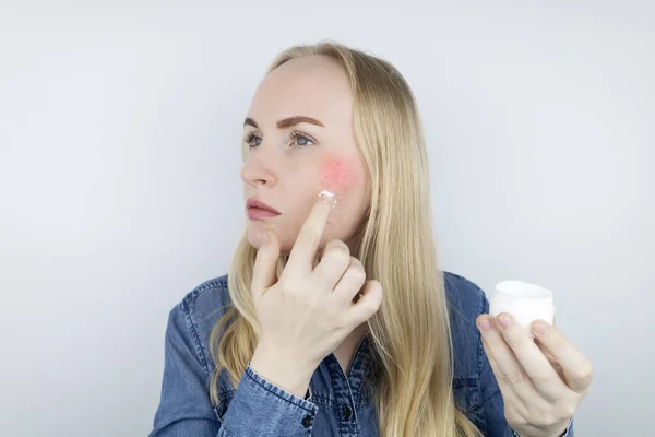 Allergie Voor Cosmetica Meisje Kreeg Acne Van Een Slechte Kwaliteit — Stockfoto