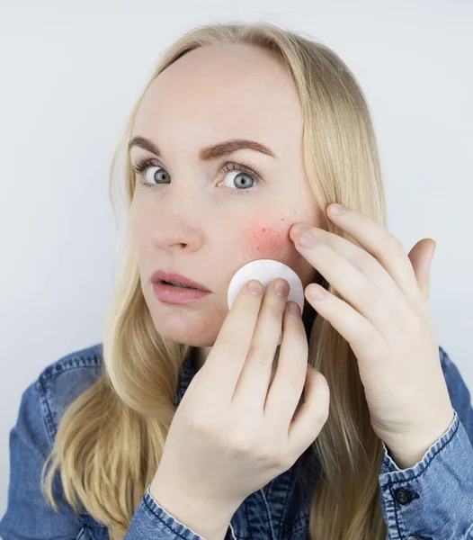 Allergie Voor Cosmetica Meisje Kreeg Acne Van Een Slechte Kwaliteit — Stockfoto