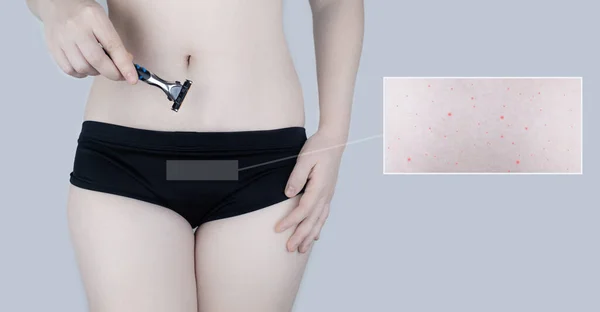 Irritación Piel Zona Del Bikini Consecuencias Depilación Lesiones Piel Espinillas — Foto de Stock