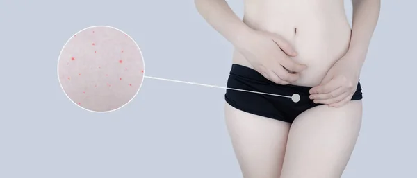 Irritazione Della Pelle Della Zona Bikini Conseguenze Della Depilazione Lesioni — Foto Stock