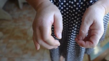 Yakın plan el iltihabı. Sol el işaret parmağının kıkırdağında çok şişkindi. Eklem iltihabı. Artrit ve artrosit. Bitişik dokularda şişlik var. Fırça karşılaştırması
