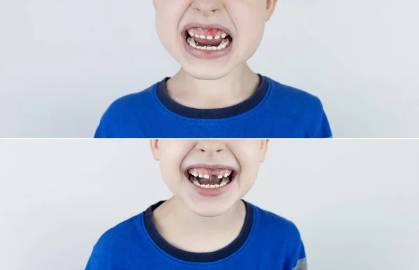 Antes Depois Cair Dente Leite Menino Loiro Foto Tem Dente — Fotografia de Stock