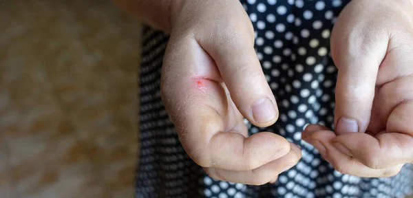 Yakın Plan Iltihabı Sol Işaret Parmağının Kıkırdağında Çok Şişkindi Eklem — Stok fotoğraf