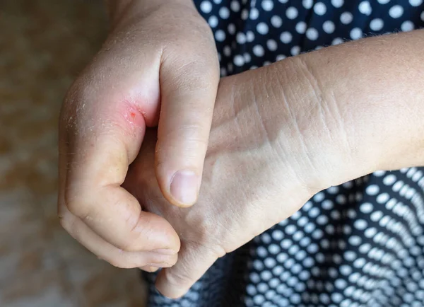 Close Hand Inflammation Left Hand Very Swollen Region Cartilages Index — Stockfoto