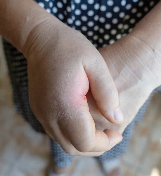 Inflamația Mâinii Aproape Mâna Stângă Fost Foarte Umflată Regiunea Cartilajelor — Fotografie, imagine de stoc