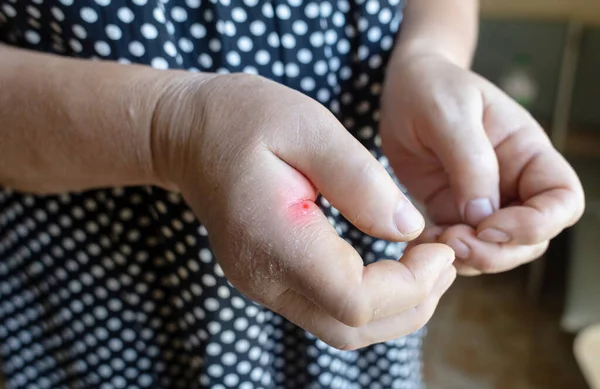 Yakın Plan Iltihabı Sol Işaret Parmağının Kıkırdağında Çok Şişkindi Eklem — Stok fotoğraf