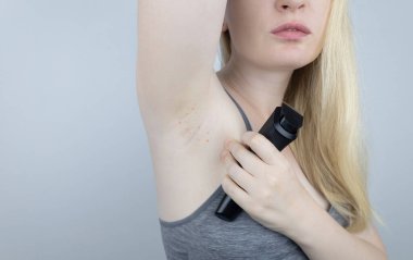 Armpit rash. Underarm skin irritation. Blonde girl shows irritation on the skin after using a razor, trimmer, deodorant or antiperspirant. Allergy or irritation. Acne or red spots