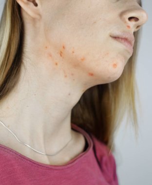 Girl shows acne on her face. Acne on the neck. Demodicosis on the chin. Redness and rash on the woman face. Acne and redness treatment. Large blisters, pits and enlarged pores