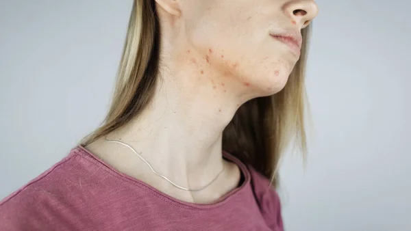 Girl Shows Acne Her Face Acne Neck Demodicosis Chin Redness — Stock Photo, Image