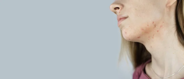 Girl Shows Acne Her Face Acne Neck Demodicosis Chin Redness — Photo