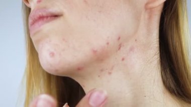 Girl shows acne on her face. Acne on the neck. Demodicosis on the chin. Redness and rash on the woman face. Acne and redness treatment. Large blisters, pits and enlarged pores