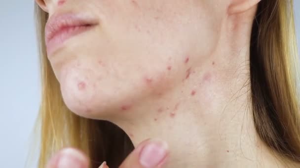 Girl Shows Acne Her Face Acne Neck Demodicosis Chin Redness — Stok Video