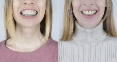 Diş tellerini çıkarmadan önce ve sonra. Solda metal parantez sisteminde bir kız var, ve sağda da düz dişler var. Gülümseme ve dişleri düzeltme kavramı. Yakın plan.
