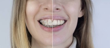 Diş tellerini çıkarmadan önce ve sonra. Solda metal parantez sisteminde bir kız var, ve sağda da düz dişler var. Gülümseme ve dişleri düzeltme kavramı. Yakın plan.