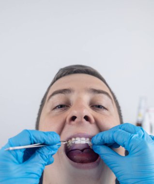 Diş telleri, köprüler ve dişlerini düzeltmek için takma bir plaka. Bir ortodontist düzgün olmayan bir çeneye bir parantez sistemi yerleştirir. Silikonlar ve gülümseme düzeltmeleri. Diş hekiminde çalışma kavramı