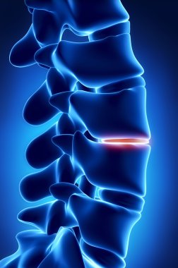disk x-ray görünümde incelme