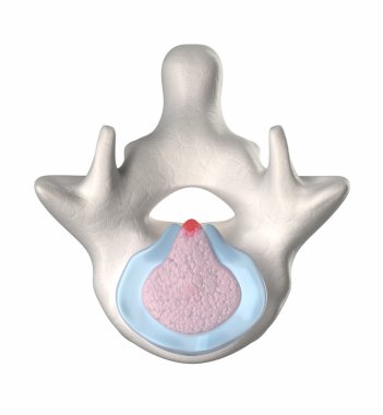 intervertebral disk dejenerasyonu - ekstrüzyon - stage 4-5