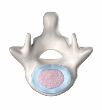 normal intervertebral disk ile çekirdek puplposus - stage 1-5