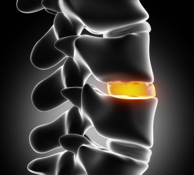 disk dejenerasyonu tarafından osteophyte - yakın çekim